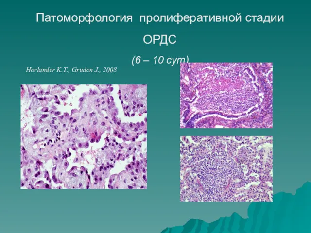 Патоморфология пролиферативной стадии ОРДС (6 – 10 сут) Horlander K.T., Gruden J., 2008