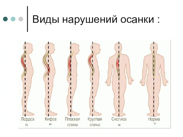 Виды нарушений осанки :