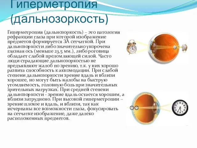 Гиперметропия (дальнозоркость) Гиперметропия (дальнозоркость) – это патология рефракции глаза при