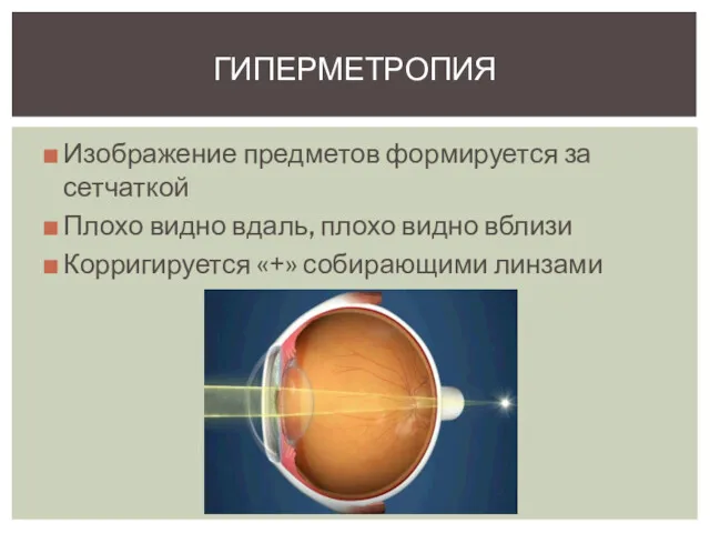 Изображение предметов формируется за сетчаткой Плохо видно вдаль, плохо видно вблизи Корригируется «+» собирающими линзами ГИПЕРМЕТРОПИЯ