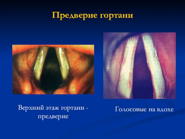 Предверие гортани Голосовые на вдохе Верхний этаж гортани - предверие