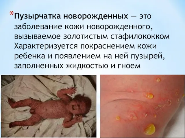 Пузырчатка новорожденных — это заболевание кожи новорожденного, вызываемое золотистым стафилококком