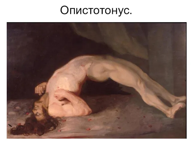 Опистотонус.