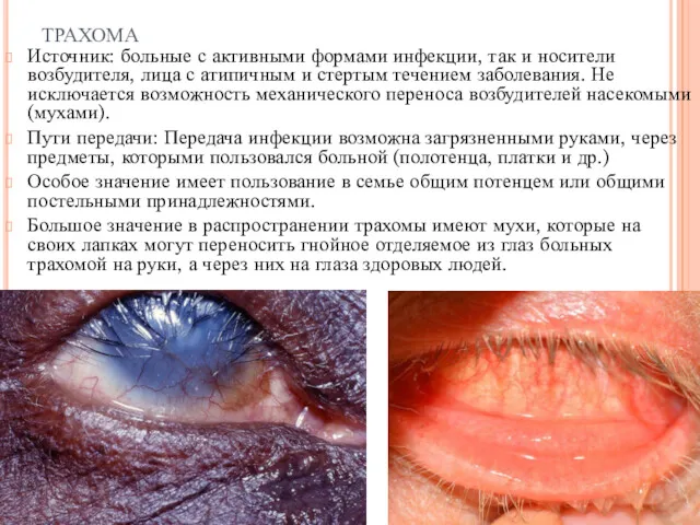 трахома Источник: больные с активными формами инфекции, так и носители