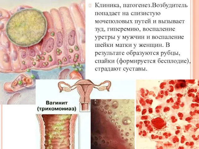 Клиника, патогенез.Возбудитель попадает на слизистую мочеполовых путей и вызывает зуд,