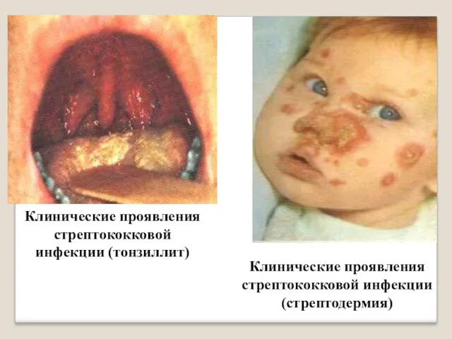 Клинические проявления стрептококковой инфекции (тонзиллит) Клинические проявления стрептококковой инфекции (стрептодермия)