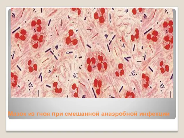 Мазок из гноя при смешанной анаэробной инфекции