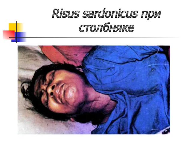 Risus sardonicus при столбняке