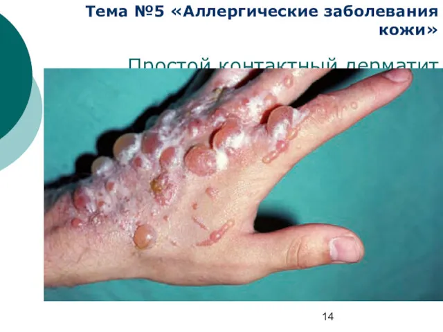 Тема №5 «Аллергические заболевания кожи» Простой контактный дерматит