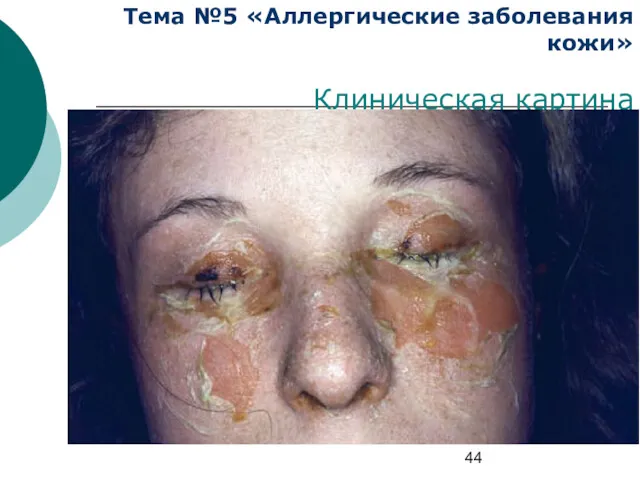 Тема №5 «Аллергические заболевания кожи» Клиническая картина