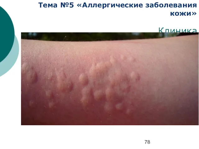 Тема №5 «Аллергические заболевания кожи» Клиника