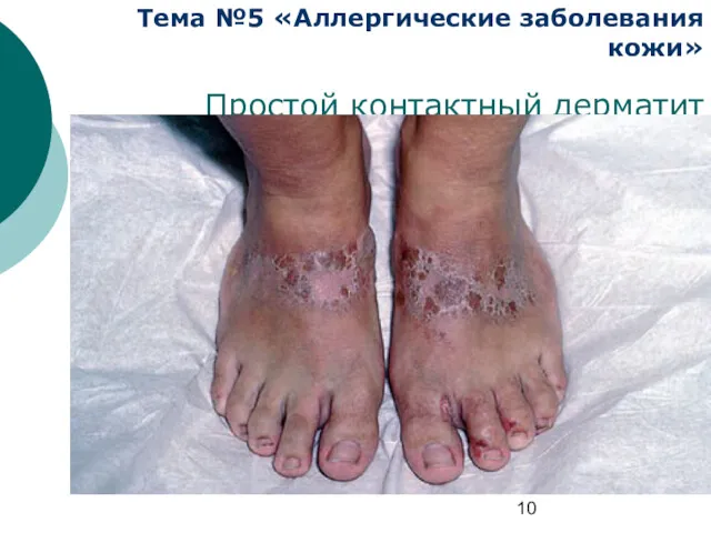 Тема №5 «Аллергические заболевания кожи» Простой контактный дерматит