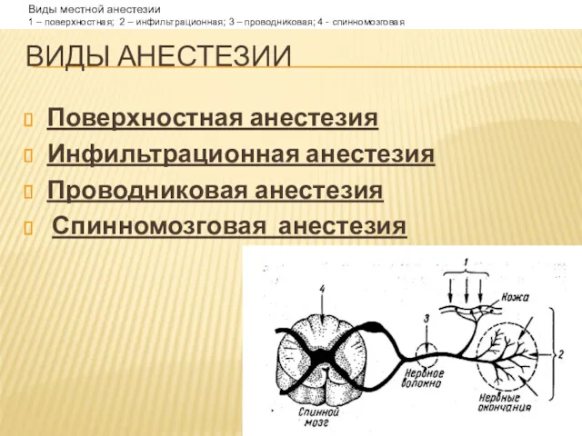 ВИДЫ АНЕСТЕЗИИ Поверхностная анестезия Инфильтрационная анестезия Проводниковая анестезия Спинномозговая анестезия