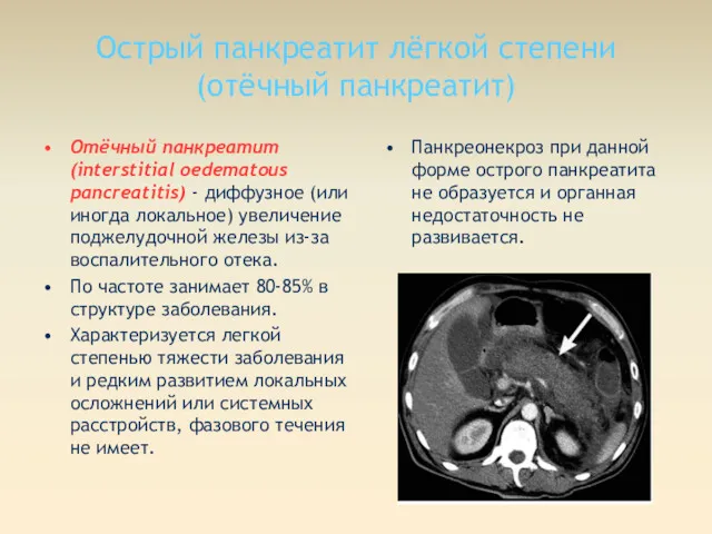 Острый панкреатит лёгкой степени (отёчный панкреатит) Отёчный панкреатит (interstitial oedematous pancreatitis) - диффузное