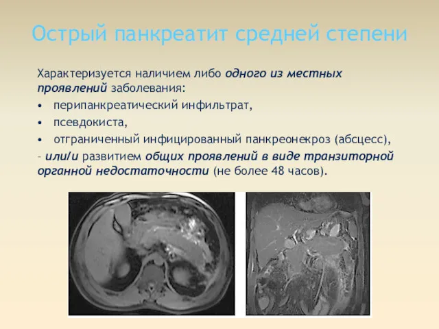 Острый панкреатит средней степени Характеризуется наличием либо одного из местных