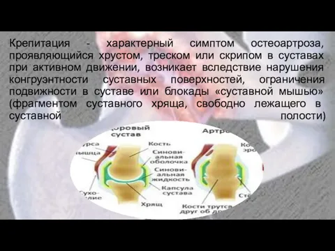 Крепитация - характерный симптом остеоартроза, проявляющийся хрустом, треском или скрипом в суставах при