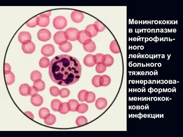 Менингококки в цитоплазме нейтрофиль- ного лейкоцита у больного тяжелой генерализова- нной формой менингокок- ковой инфекции