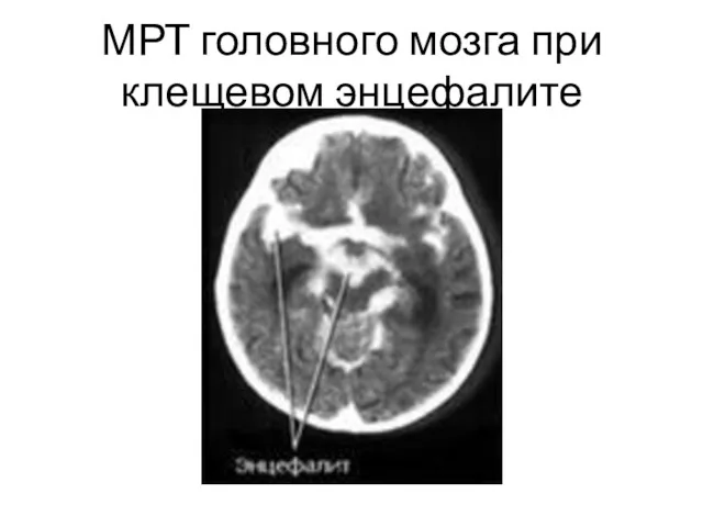 МРТ головного мозга при клещевом энцефалите