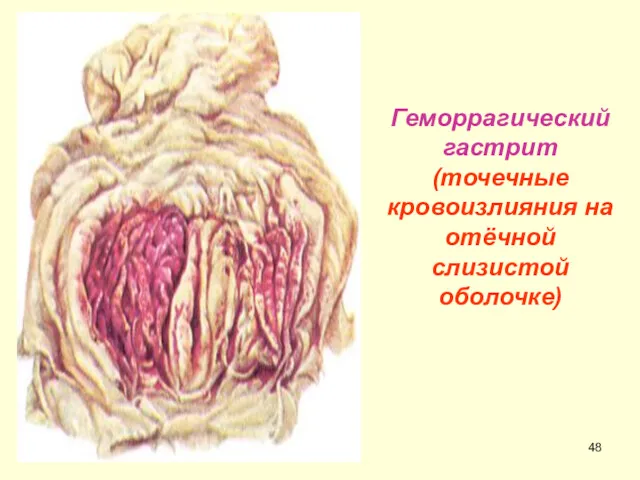 Геморрагический гастрит (точечные кровоизлияния на отёчной слизистой оболочке)