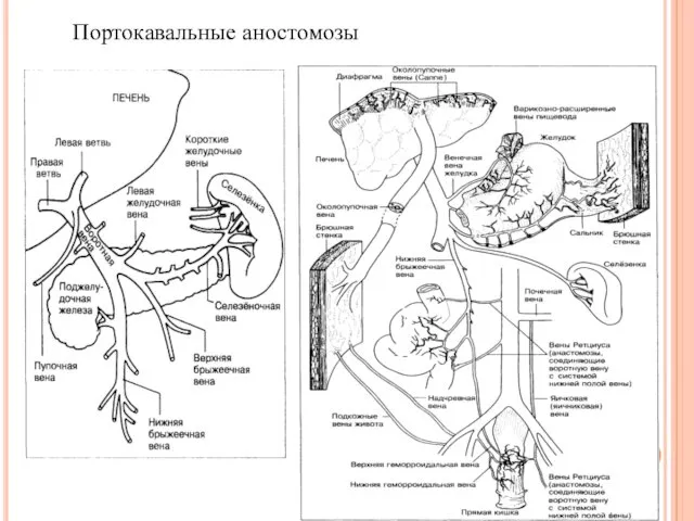 Портокавальные аностомозы