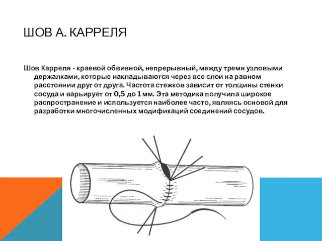 ШОВ А. КАРРЕЛЯ Шов Карреля - краевой обвивной, непрерывный, между