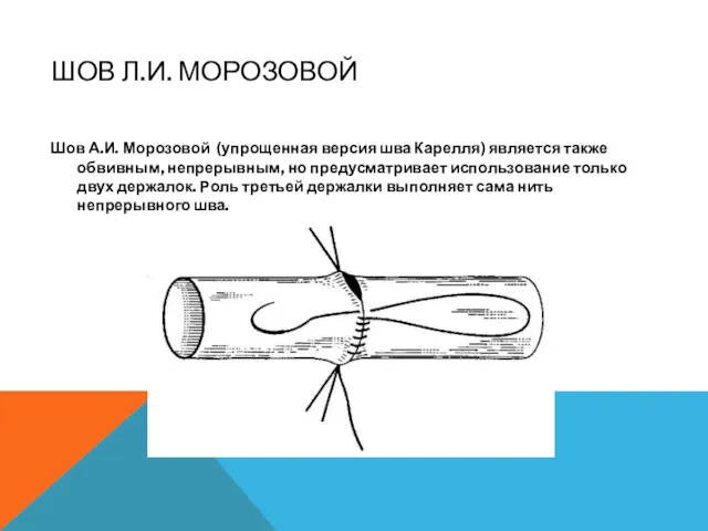 ШОВ Л.И. МОРОЗОВОЙ Шов А.И. Морозовой (упрощенная версия шва Карелля)