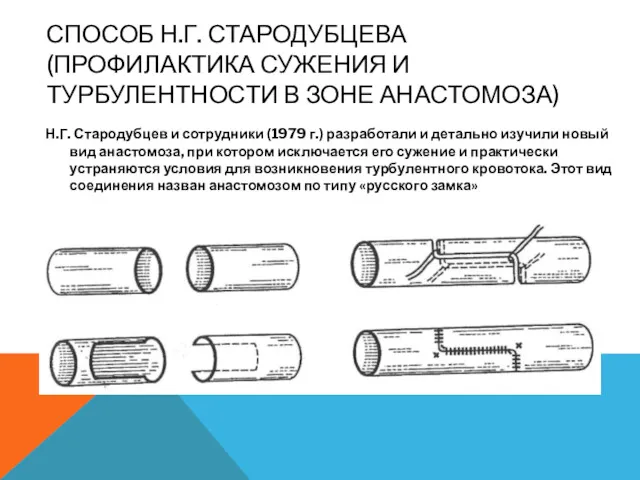 СПОСОБ Н.Г. СТАРОДУБЦЕВА (ПРОФИЛАКТИКА СУЖЕНИЯ И ТУРБУЛЕНТНОСТИ В ЗОНЕ АНАСТОМОЗА)