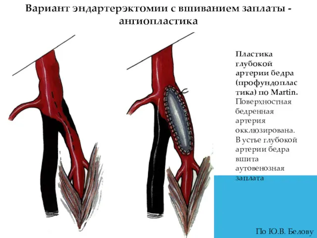 Вариант эндартерэктомии с вшиванием заплаты - ангиопластика Пластика глубокой артерии