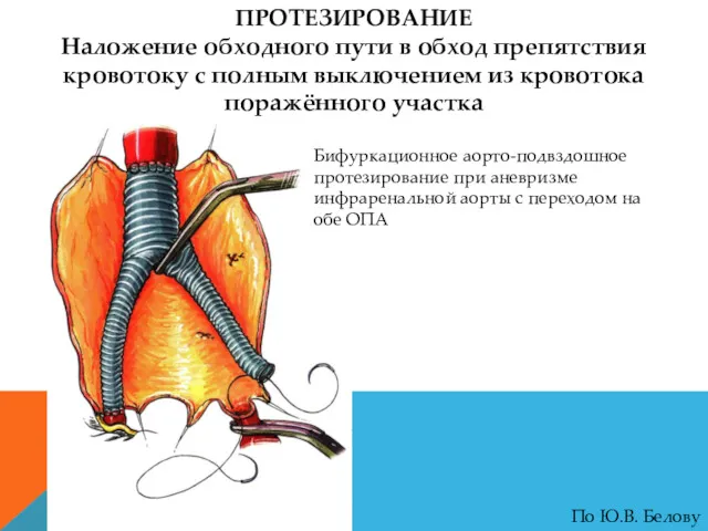 ПРОТЕЗИРОВАНИЕ Наложение обходного пути в обход препятствия кровотоку с полным