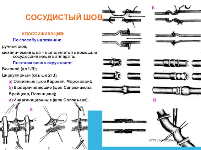 СОСУДИСТЫЙ ШОВ КЛАССИФИКАЦИЯ: По способу наложения: ручной шов; механический шов