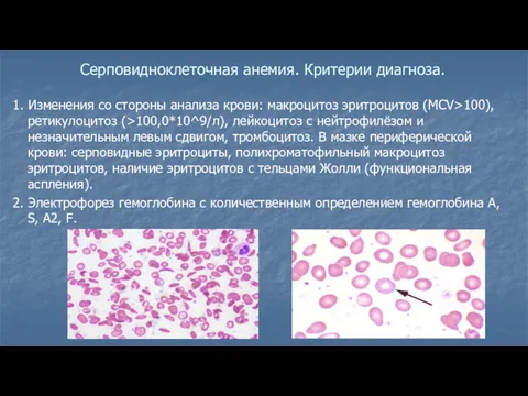 Серповидноклеточная анемия. Критерии диагноза. 1. Изменения со стороны анализа крови: