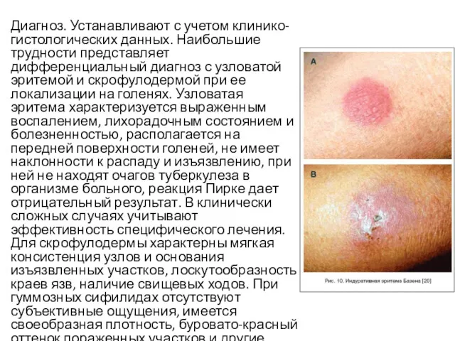 Диагноз. Устанавливают с учетом клинико-гистологических данных. Наибольшие трудности представляет дифференциальный