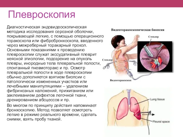 Плевроскопия Диагностическая эндовидеоскопическая методика исследования серозной оболочки, покрывающей легкие, с