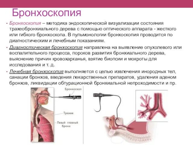 Бронхоскопия Бронхоскопия – методика эндоскопической визуализации состояния трахеобронхиального дерева с