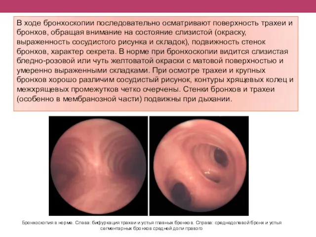 В ходе бронхоскопии последовательно осматривают поверхность трахеи и бронхов, обращая