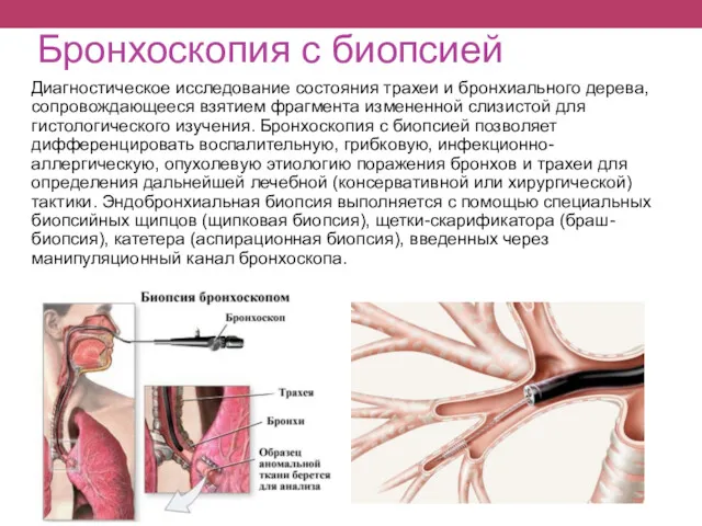 Бронхоскопия с биопсией Диагностическое исследование состояния трахеи и бронхиального дерева,