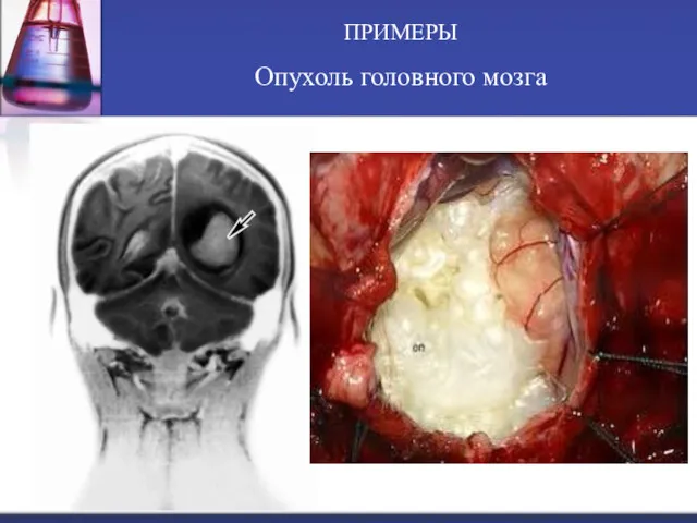 ПРИМЕРЫ Опухоль головного мозга