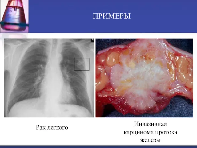 Рак легкого ПРИМЕРЫ Инвазивная карцинома протока железы