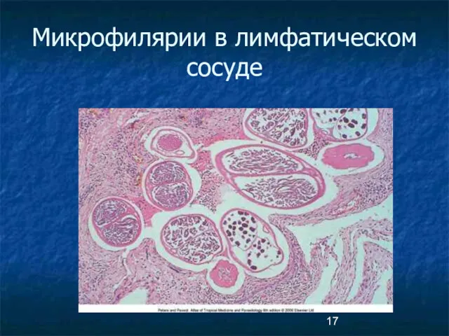 Микрофилярии в лимфатическом сосуде