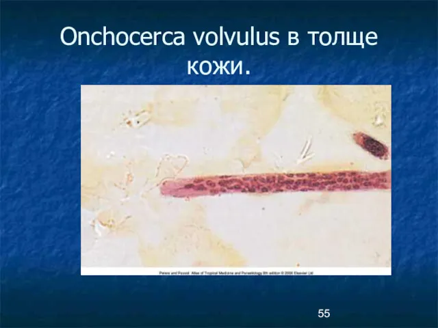Onchocerca volvulus в толще кожи.
