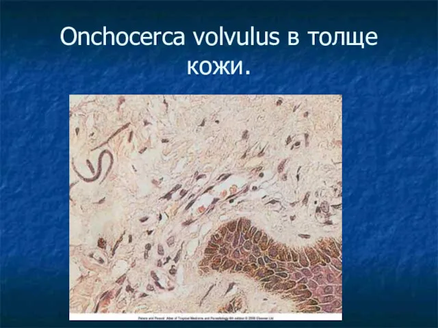 Onchocerca volvulus в толще кожи.