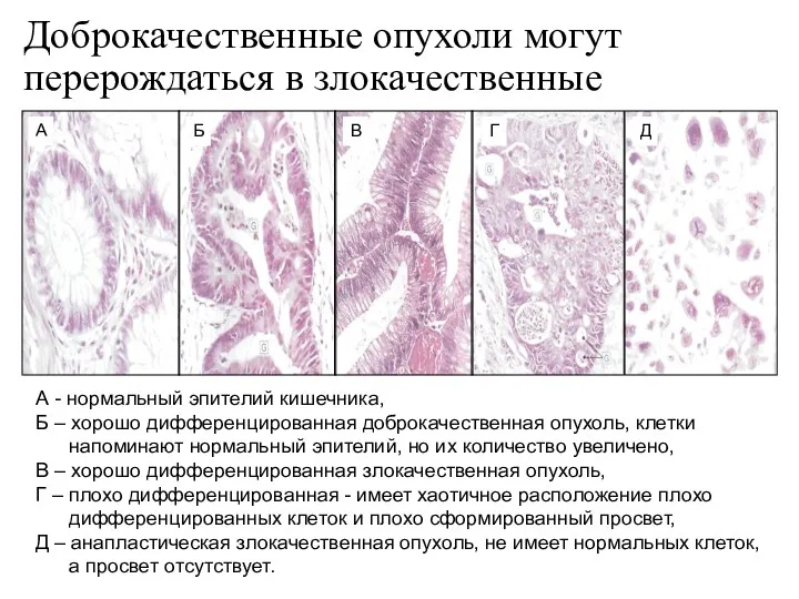 Доброкачественные опухоли могут перерождаться в злокачественные А - нормальный эпителий