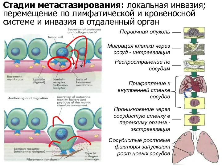 Стадии метастазирования: локальная инвазия; перемещение по лимфатической и кровеносной системе и инвазия в отдаленный орган