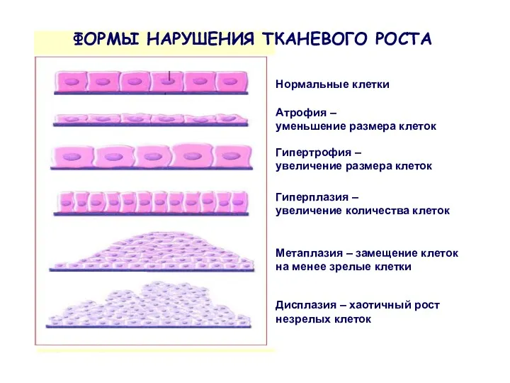 Атрофия – уменьшение размера клеток Гипертрофия – увеличение размера клеток