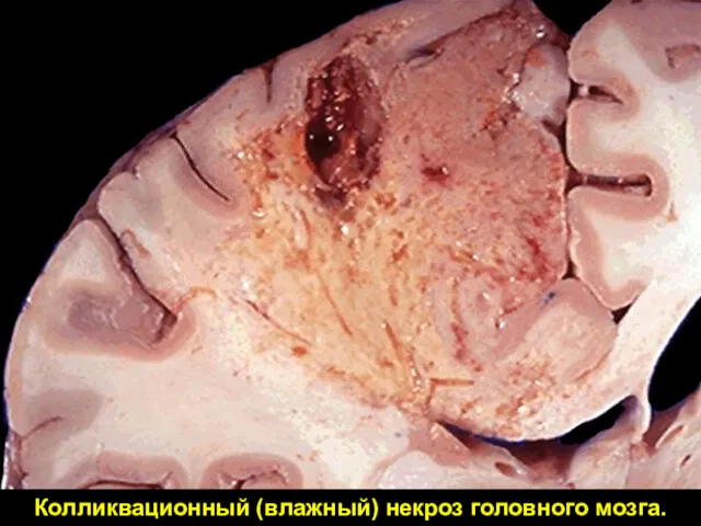 Колликвационный (влажный) некроз головного мозга.