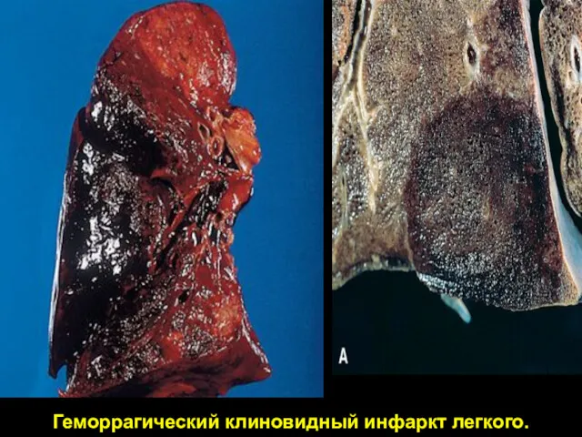 Геморрагический клиновидный инфаркт легкого.