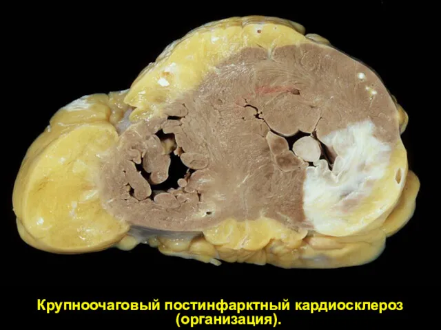 Крупноочаговый постинфарктный кардиосклероз (организация).