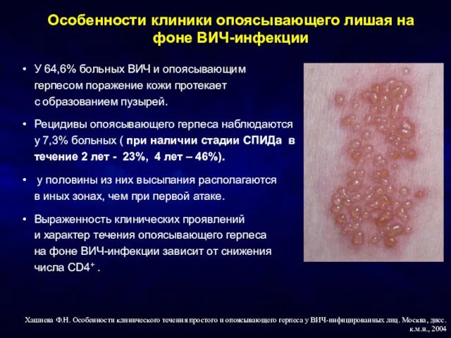 Особенности клиники опоясывающего лишая на фоне ВИЧ-инфекции У 64,6% больных