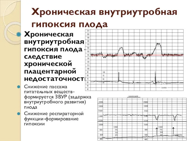 Хроническая внутриутробная гипоксия плода Хроническая внутриутробная гипоксия плода – следствие