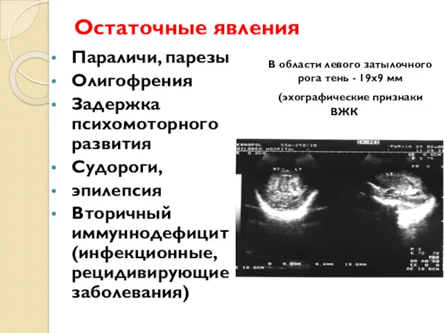 Остаточные явления Параличи, парезы Олигофрения Задержка психомоторного развития Судороги, эпилепсия